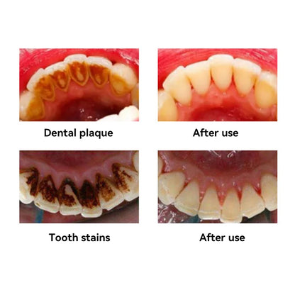 Oral Plaque & Tartar Remover